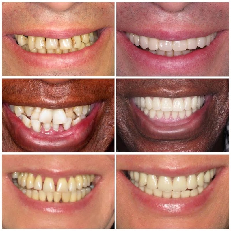 All on 4 Dental Implants Westchester